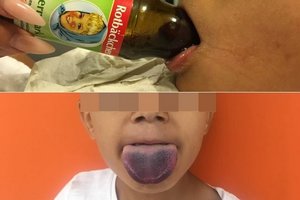Gydytojai berniuko liežuvį vadavo vyno butelio atidarytuvu