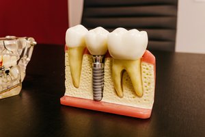 6 dalykai, kuriuos verta žinoti apie dantų implantus
