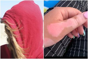 Kaunietė gyvena su nepagydoma odos liga: nuo vaikystės lydi kreivi žvilgsniai ir nemalonūs klausimai