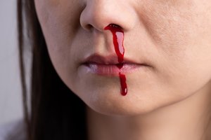 Kraujas iš nosies įspėjo apie sunkią kaunietės ligą: sutriko net du gyvybiškai svarbūs organai