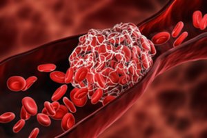 Didžiulės apimties tyrimas nustatė, kaip ilgai išlieka kraujo krešulių rizika po persirgimo COVID-19