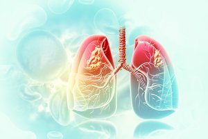 Klastingasis plaučių uždegimas: atsakė, kada liga atneša staigią mirtį