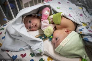 Atskirtos kepenimis suaugusios 4 mėn. Siamo dvynės: iki paskutinės minutės medikai nebuvo tikri savo sėkme 