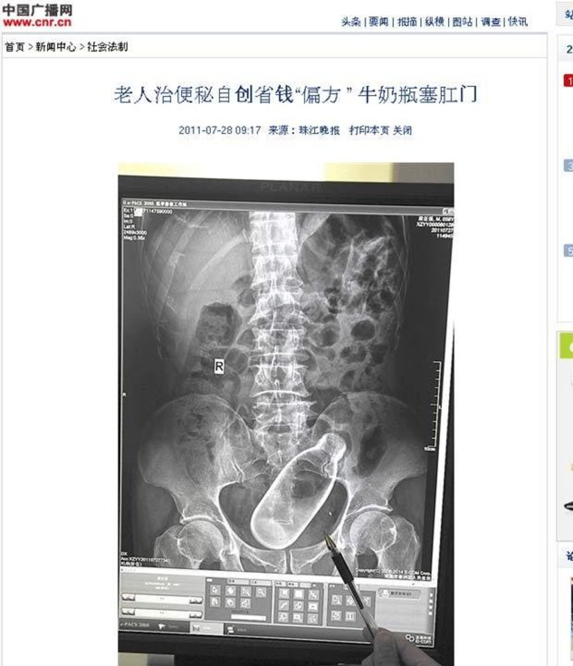 Šešiasdešimtmetis vyriškis greitosios pagalbos buvo atgabentas į Xiangzhou miesto ligoninę po to, kai pats sau į išeinamąją angą įvedė butelį.
