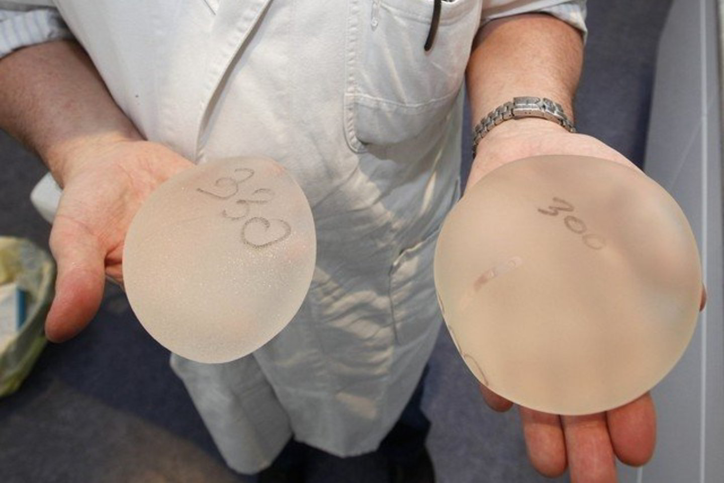 Plastinė operacija Nicos klinikoje.