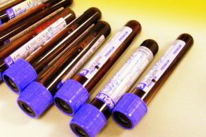 Prostatos prevencinės patikros rezultatai šokiravo medikus