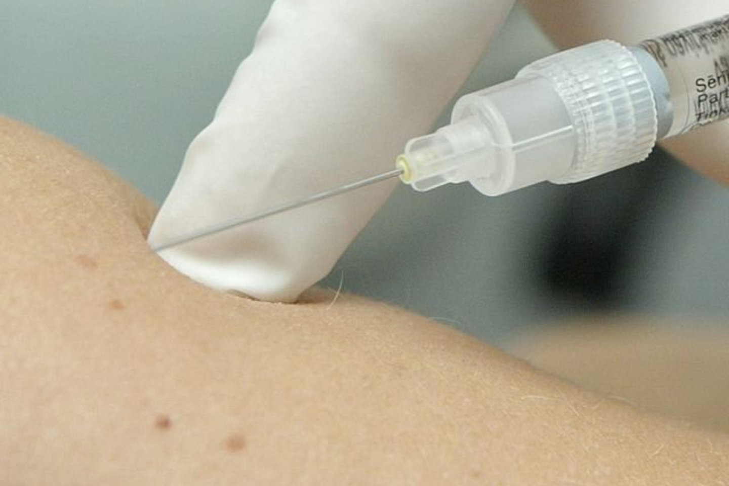 Pneumokokinė infekcija – tai itin plačiai paplitusi bakterinė infekcija, galinti sukelti labai sunkias komplikacijas.