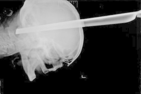 Rusijoje medikai pacientui iš galvos ištraukė taburetės koją