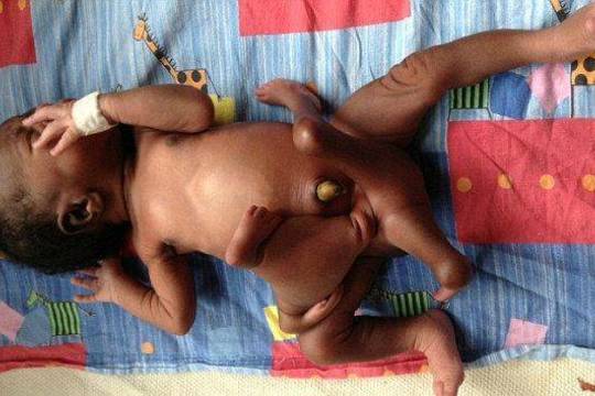 Ugandoje gimė kūdikis su keturiomis rankomis ir kojomis