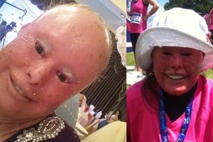 Žvynais padengta moteris iš visų jėgų kabinasi į gyvenimą