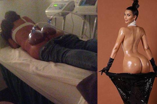 Dėl Kim Kardashian užpakalio moterys gula po siurbtukais