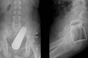 Rentgeno nuotraukose – keisčiausi išangėse įstrigę daiktai