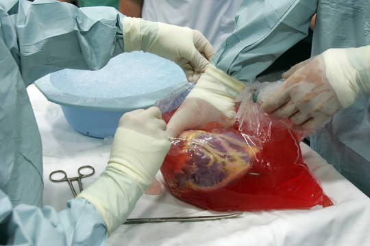 Vilniuje atlikta 100-toji širdies persodinimo operacija