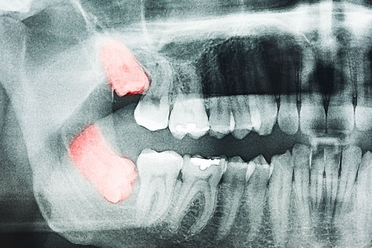 Kreivai augantys protiniai dantys dažnai būna įsirėmę į krūminius, dėl to tarpą tarp šių dantų būna sunku išvalyti ir jie genda.<br>„123rf.com“ nuotr.