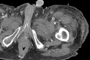 Baisiausias vyro košmaras: dėl ko tenka amputuoti penį?