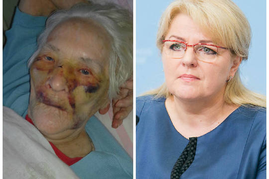 Mėlynės ant senolės veido išjudino ministeriją, bet ne policiją