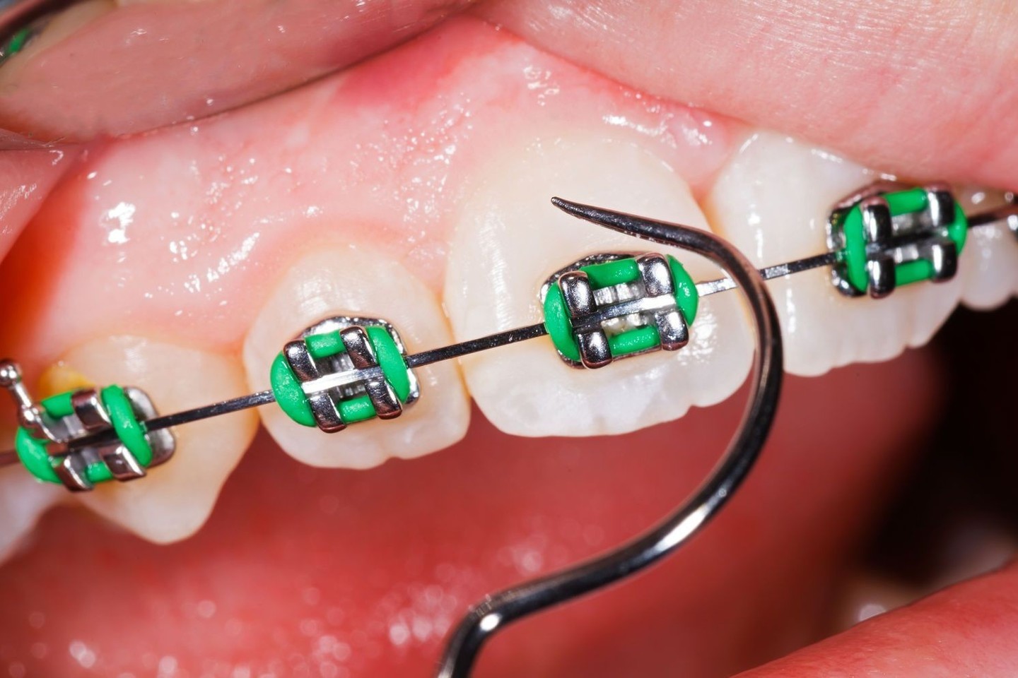 Didžioji dalis pacientų dantis dažniausiai tiesinasi ne dėl sveikatos problemų, o dėl estetikos ir grožio.<br>123rf nuotr.