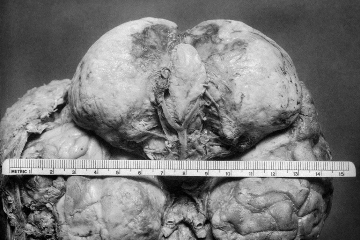 Praėjus šimtmečiui paviešintos smegenų operacijų nuotraukos.<br>Yale'io universiteto nuotr.