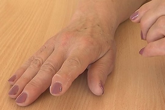 Smulkiųjų sąnarių ligos, deformuoti pirštai ir skausmas (I)