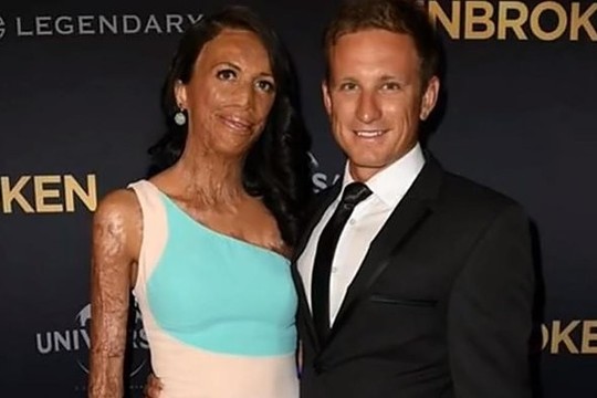 Gaisrą išgyvenusio modelio istorija privers patikėti tikra meile