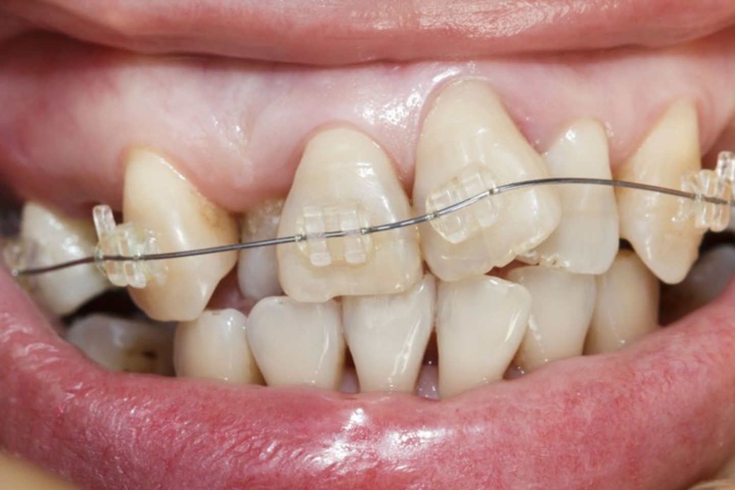 Gydytojų ortodontų įsikišimas būtinas tada, kai dėl netaisyklingos dantų padėties didėja karieso ir periodonto ligų atsiradimas.<br>123rf nuotr.