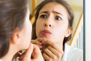 Kurią veido vietą beria spuogai? Tai daug pasako apie sveikatą