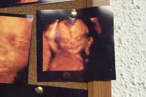 Būsimieji tėvai pakraupę: echoskopijoje pamatė demono veidą