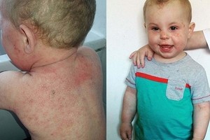 Mažylio kančios: dėl siaubingos ligos oda kraujuoja kasdien