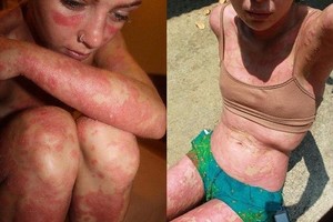 Žvyneline serganti mergina: „Aš nesigėdiju savo kūno“