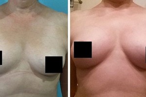 Stebuklingoji liemenėlė – veikia geriau nei plastinė chirurgija?