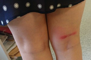 Menkiausias uodo įkandimas – jau viena koja karste