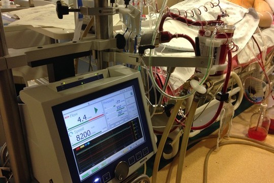 Kovoje dėl pacientų gyvybės gelbsti EKMO sistema