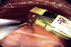 Radinys paciento skrandyje nustebino net visko mačiusį chirurgą