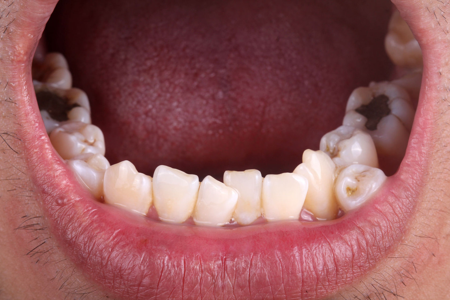 Išrautas dantis – liga, pavojus uždegiminiams procesams.<br>123rf nuotr.
