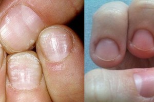 Pažvelkite į nagus: juose užkoduotas net paralyžius