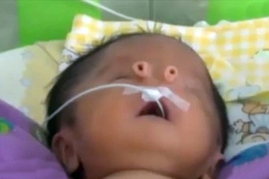 Neįprastos išvaizdos naujagimis – vietoje nosies du straubliukai