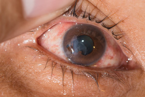 Kodėl silpnėja regėjimas ir kaip to išvengti?