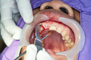 Dantų netekusiems žmonėms siūlo naują išeitį