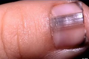 Dėmė ant nago pranašavo baisią ligą: teko amputuoti pirštą