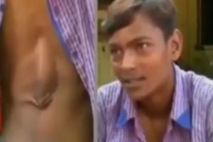 Dėl retos patologijos vaikino širdis plaka išorėje