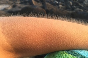 Šiurpsta oda ar žagsite? Sužinokite, kodėl taip nutinka