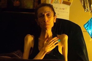 Lieknėjimo manija aktorę pavertė pusiau lavonu