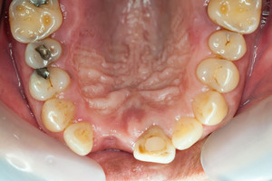 Bedančių tauta: kodėl visus dantis turi tik kas trečias žmogus?