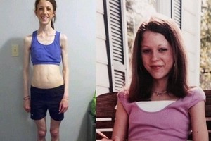 Anoreksija sergančią merginą išgelbėjo netikėtas įvykis