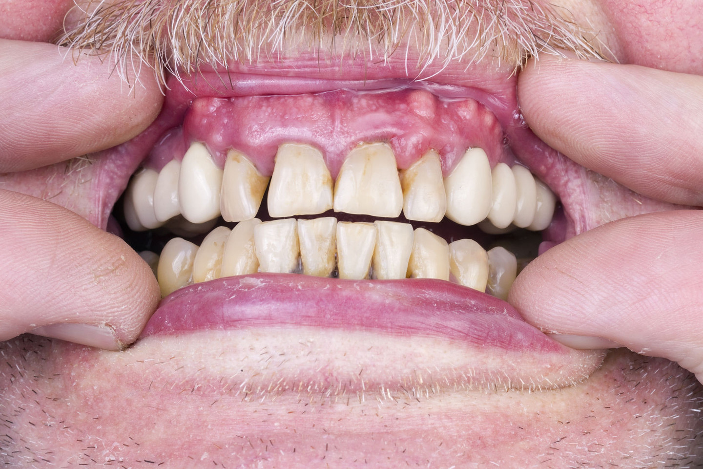 Dėl blogo sąkandžio gali atsirasti dantų skausmas.<br>123rf nuotr.