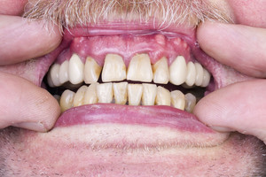 Kokius negalavimus gali sukelti blogas sąkandis?