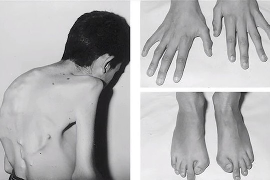 Pamatykite: 10 baisiausių pasaulio ligų