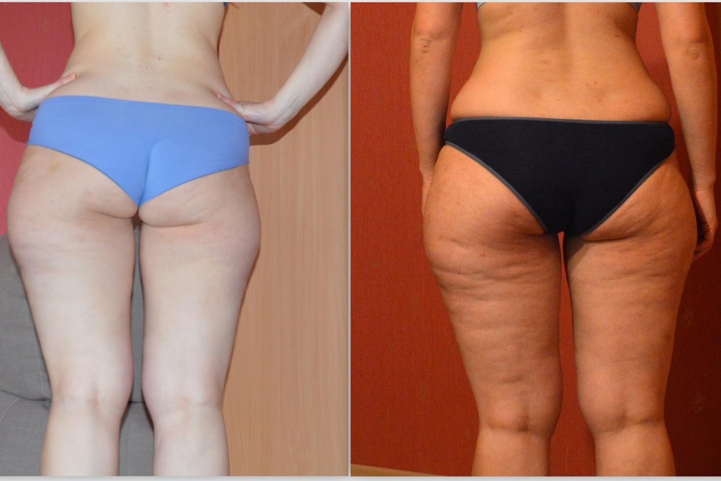 Salono klientei vos po 3 savaičių, apimtys sumažėjo net po 3 centimetrus per šlaunis ir klubus.<br>Asmeninio archyvo nuotr.