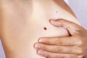 Ką apgamai pasako apie jus ir jūsų likimą