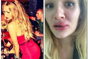 Nepavykusi injekcija į lūpas subjaurojo merginos veidą